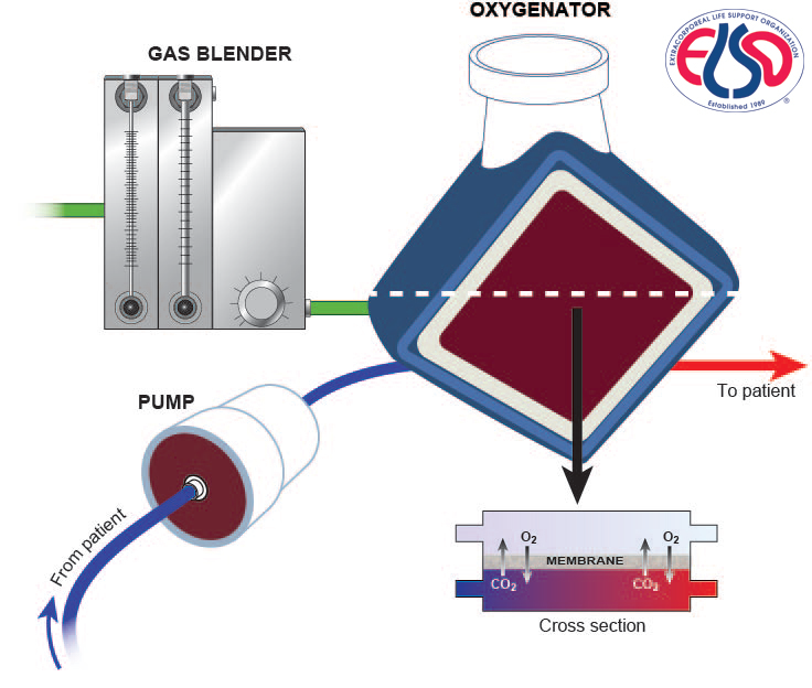 ECMO | Critical Care Corner | E3 Learning