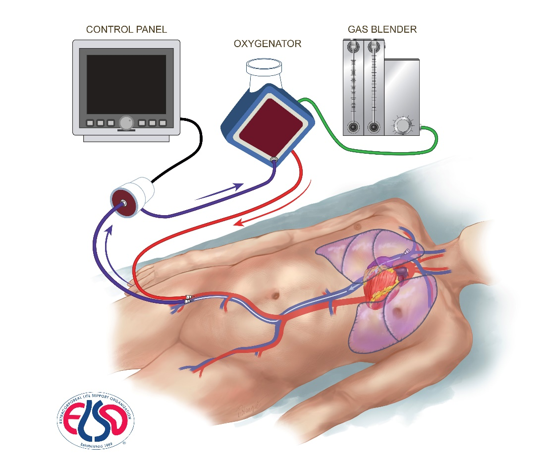 ECMO | Critical Care Corner | E3 Learning