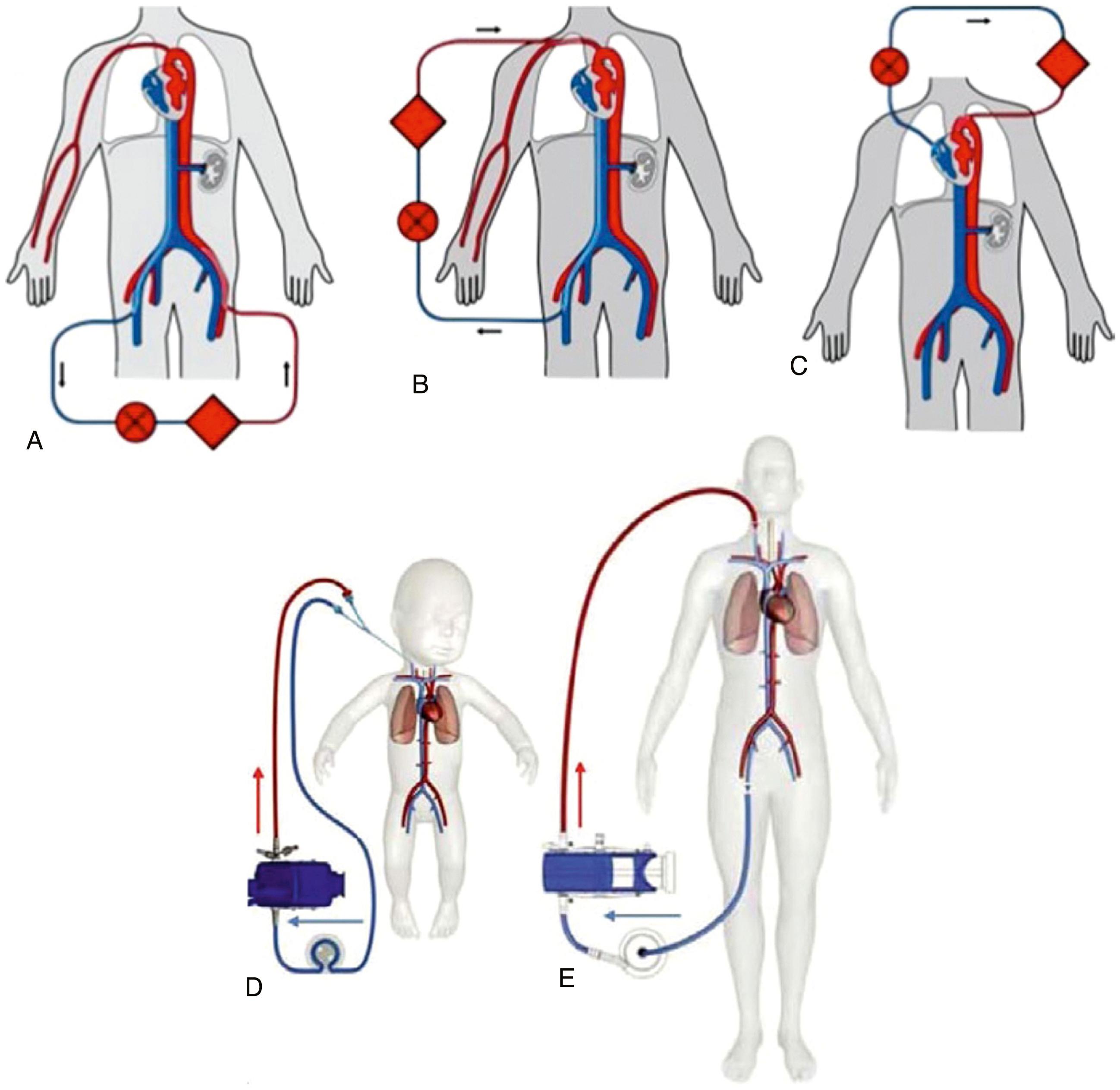 VV vs VA ECMO comparison diagram