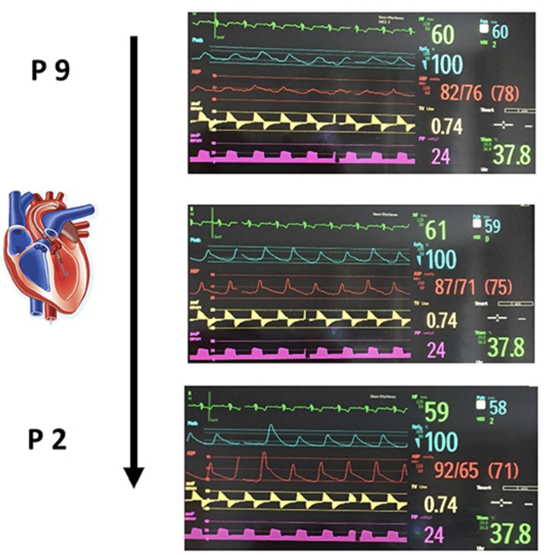 Impella console waveforms