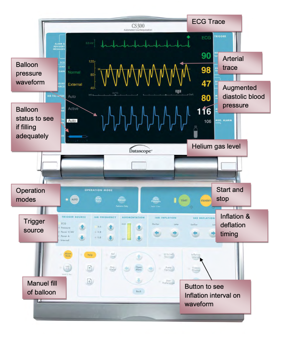 IABP console interface showing waveforms