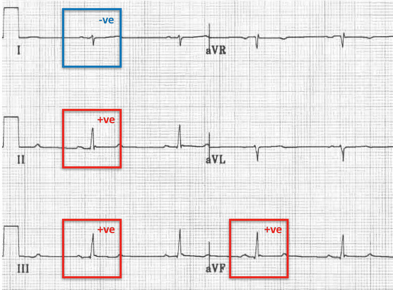 Rightward axis with negative QRS in leads I and aVL and upright QRS in II, III and aVF