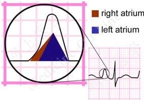 ECG strip showing P pulmonale