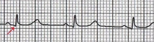 Normal Q wave in lead V6