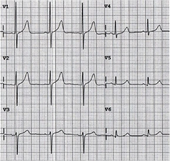 Leads V1 and V3 reversed
