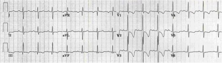 Right ventricular hypertrophy with dominant R in V1