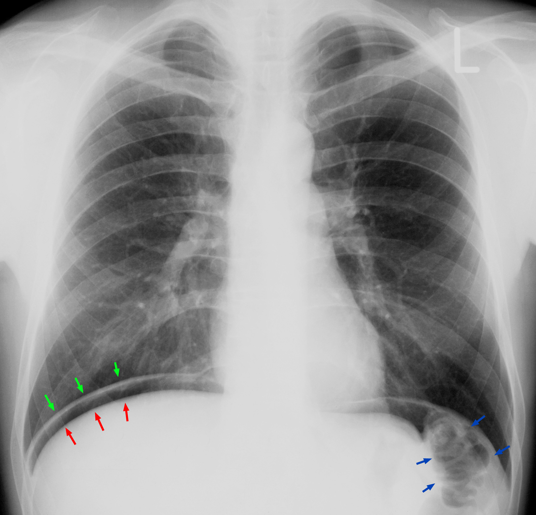 Upright chest radiograph with a crescent of free air under the right hemidiaphragm (arrows), a sign of perforation