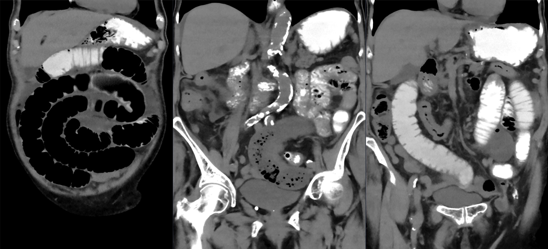 Coronal CT series of small bowel obstruction from an incarcerated femoral hernia, with dilated small bowel loops and feculent content