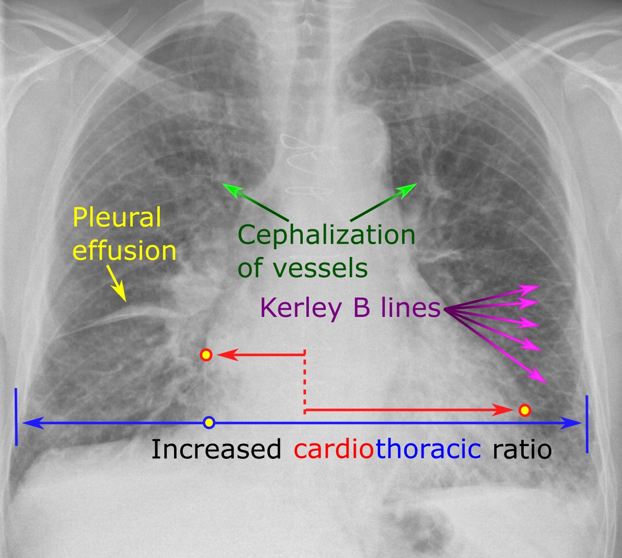 Chest radiograph in heart failure with Kerley B lines, an enlarged heart and small effusion, without obvious alveolar edema