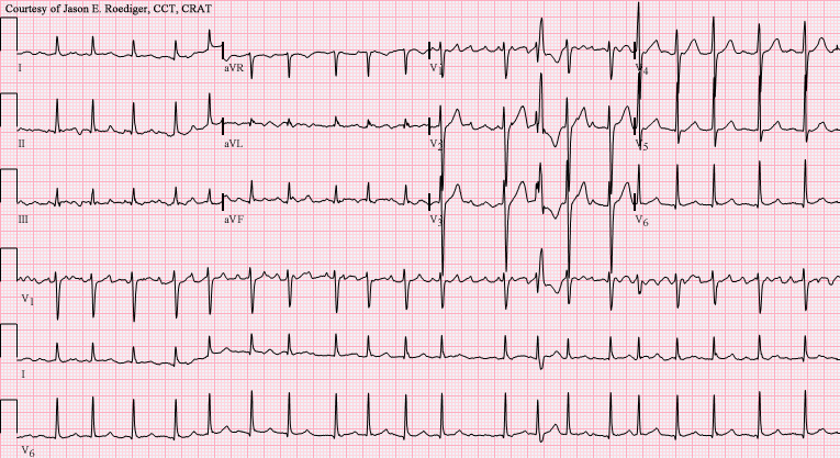 ECG of atrial fibrillation with rapid ventricular response and intermittent wide QRS complexes from aberrant conduction