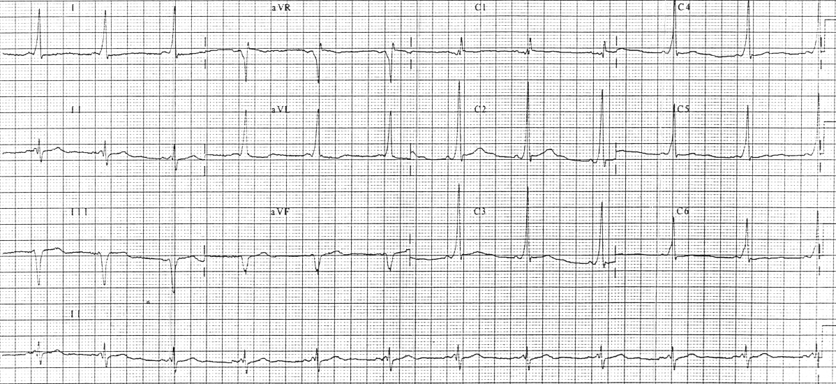 12-lead ECG of Wolff-Parkinson-White syndrome with short PR and delta waves