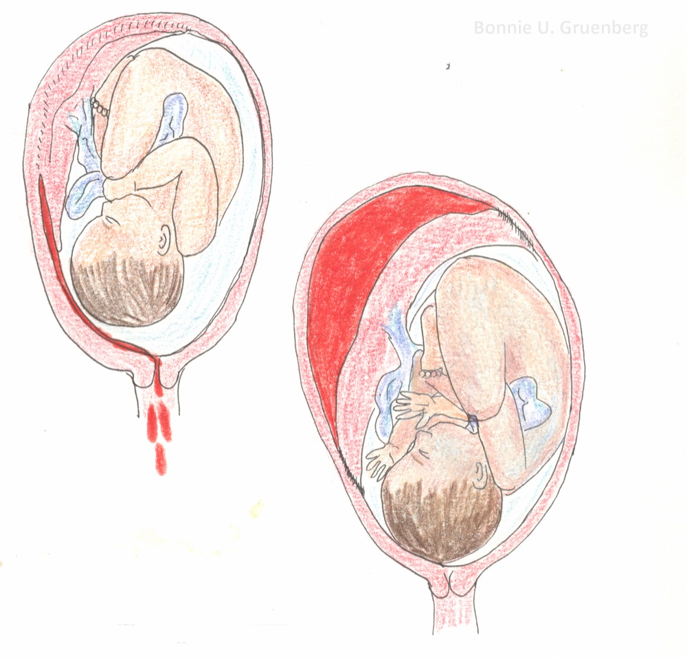 Drawings of marginal and concealed placental abruption: blood collecting between placenta and uterine wall