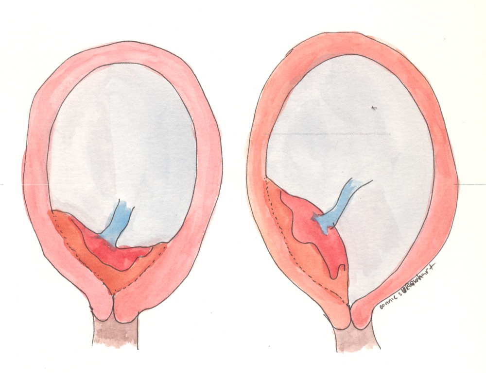 Watercolor of marginal and complete placenta previa, with the placenta covering the internal cervical os