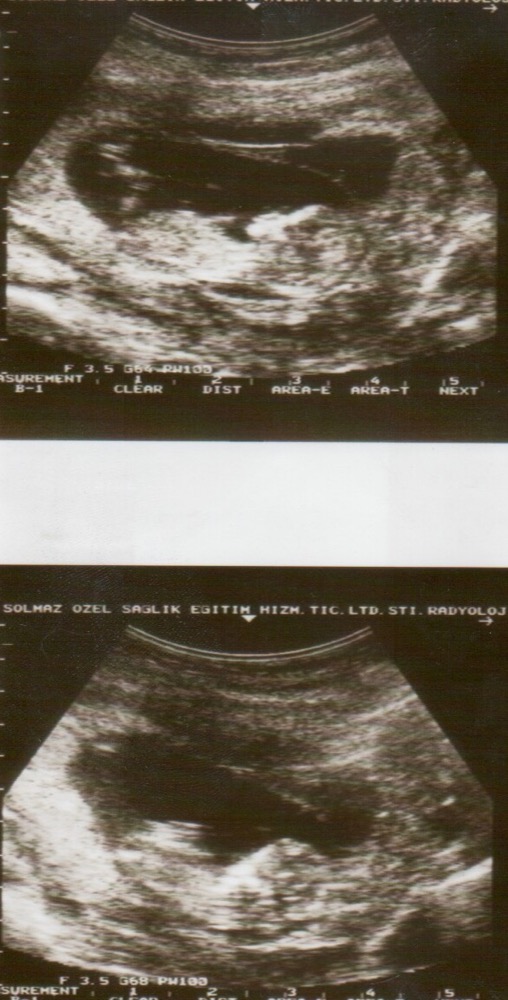 Ultrasound image of a detached placenta: a separated layer of placenta outlined against the uterine wall
