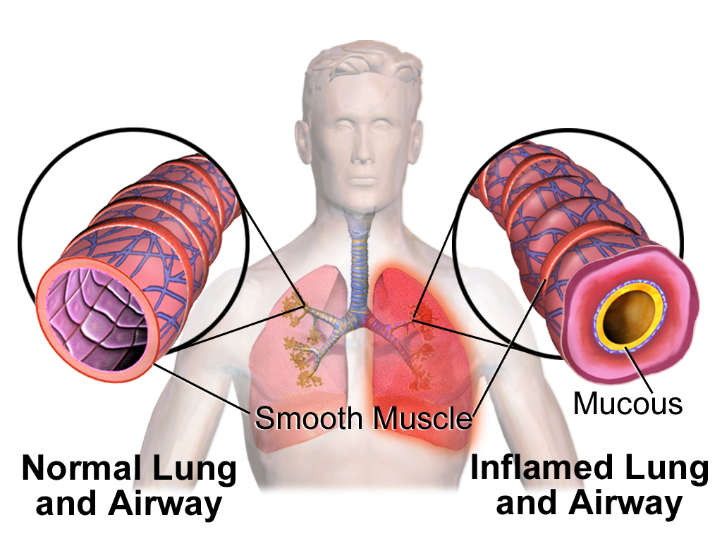 Normal airway with an open lumen beside an inflamed airway with a thickened wall, smooth muscle and mucus