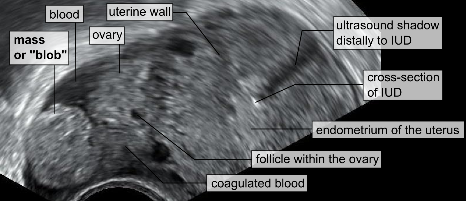 Vaginal ultrasound: a blob-shaped adnexal mass beside the ovary, separate from it, with an IUD in the uterus