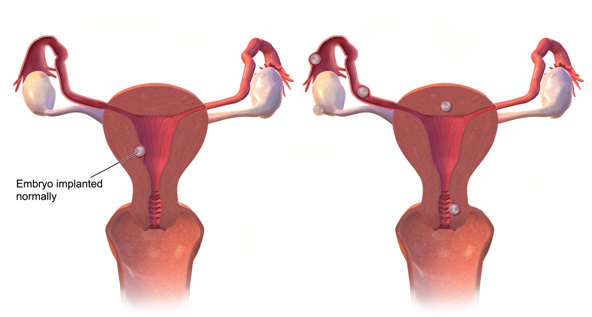 Normal implantation in the uterine cavity (left); ectopic implantation sites outside the cavity (right)