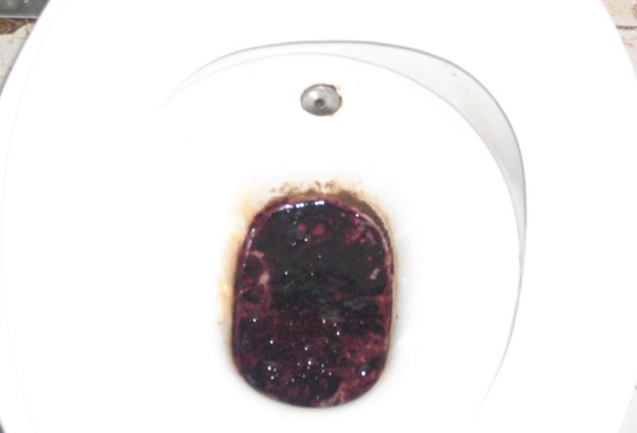 Melena: black, tarry, sticky stool in a toilet bowl from a bleeding duodenal ulcer