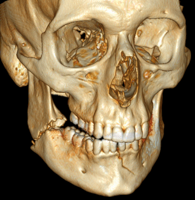 3D CT reconstruction showing mandible fractures with orbital floor and nasal bone fractures