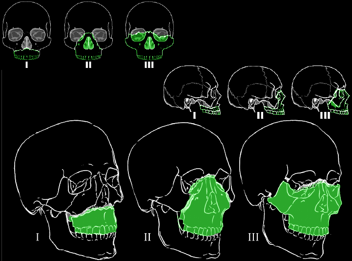 Le Fort I, II and III midface fracture patterns shown on skull outlines in front and side views
