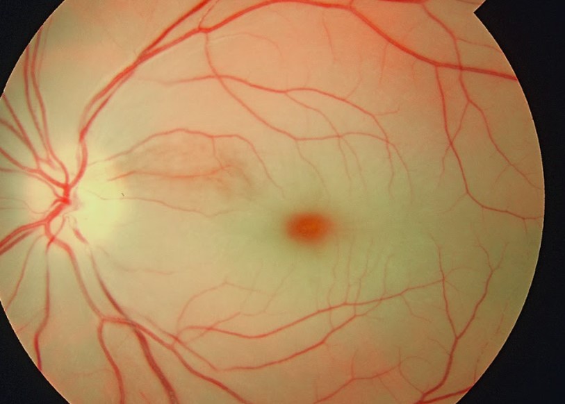 Fundus photograph in central retinal artery occlusion showing retinal swelling and a cherry-red spot at the macula