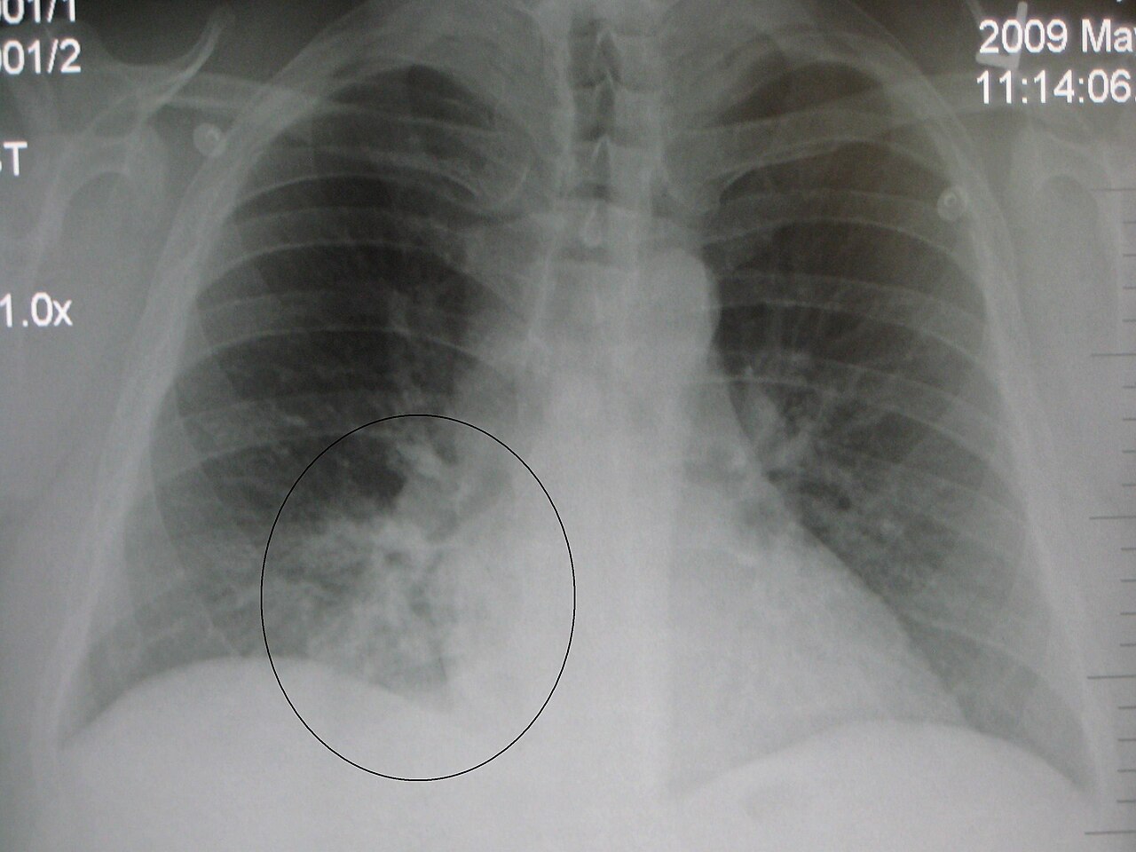 Frontal chest X-ray with a circled right lower lobe airspace opacity consistent with pneumonia