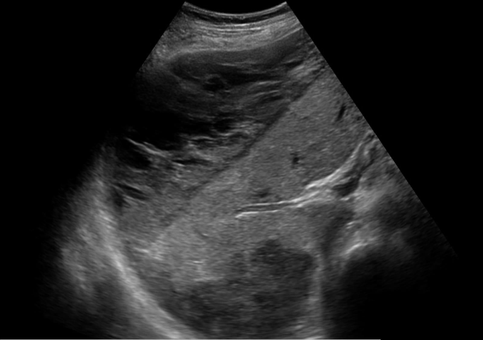 Ultrasound of a large subcapsular hematoma of the liver in a patient with HELLP syndrome