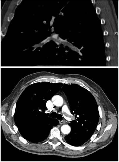 CT pulmonary angiogram showing a saddle embolus, with thrombus in the lobar branches of both main pulmonary arteries