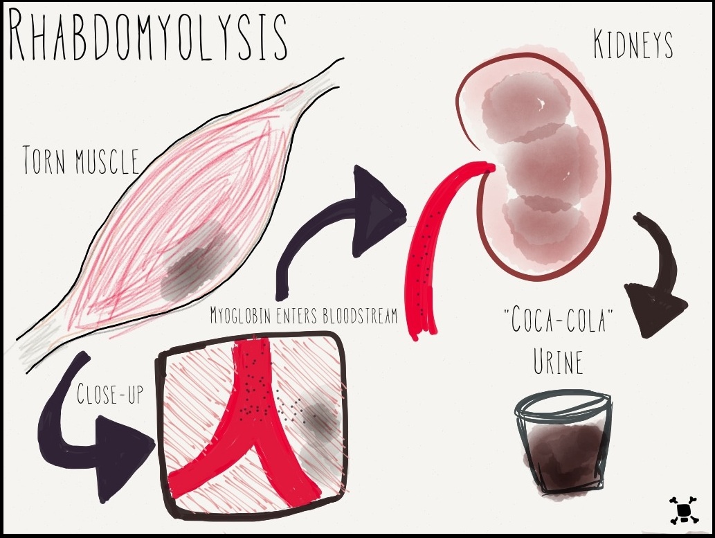 Diagram: torn muscle releases myoglobin into the bloodstream, which reaches the kidneys and darkens the urine