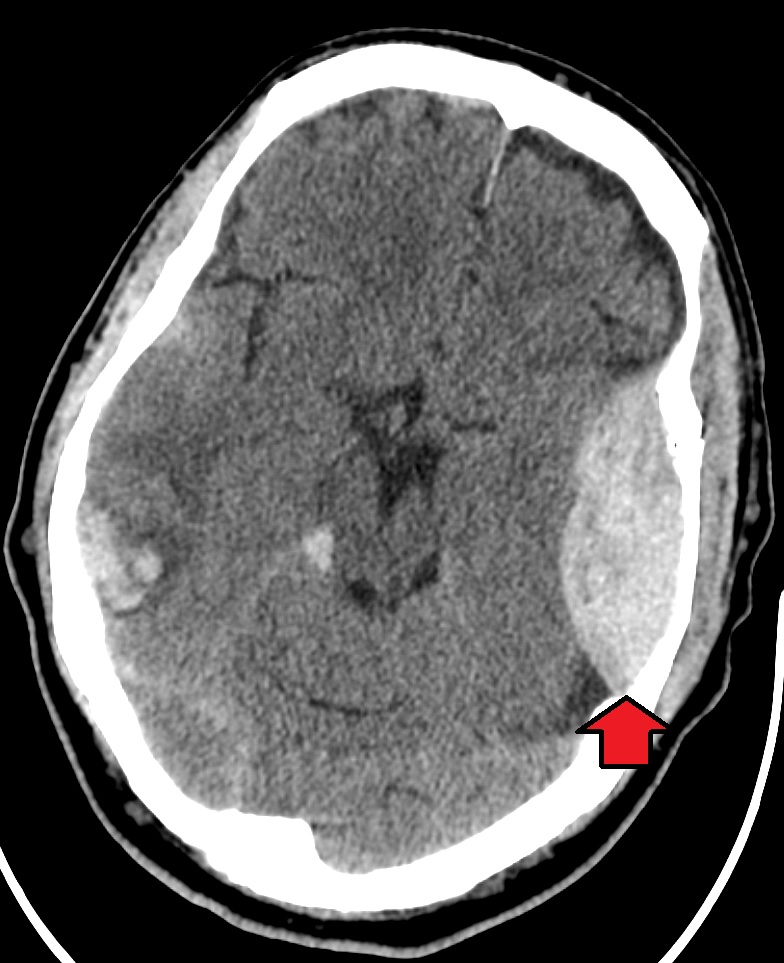 Axial head CT with a lens-shaped hyperdense epidural hematoma on the patient's left side, arrow marking the collection