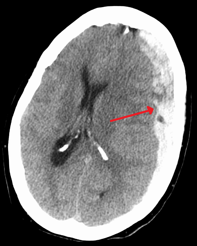 Axial head CT with a large subdural hematoma and midline shift, arrow marking the hematoma edge