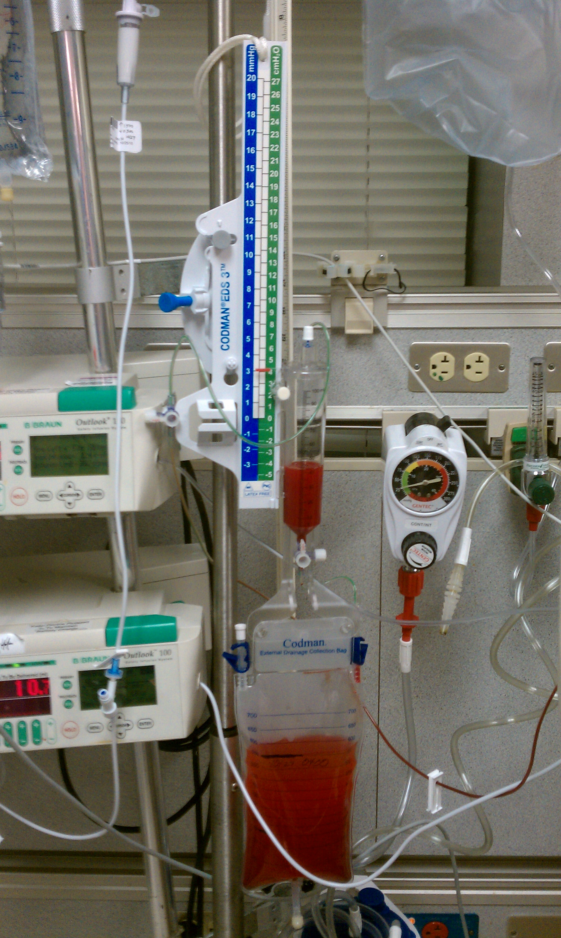 Codman EVD drainage system with a leveling scale and blood-tinged CSF in the collection bag