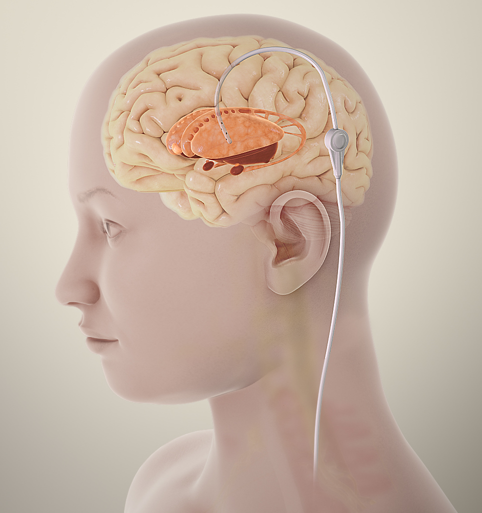 Illustration of a catheter entering the lateral ventricle through the skull to measure ICP