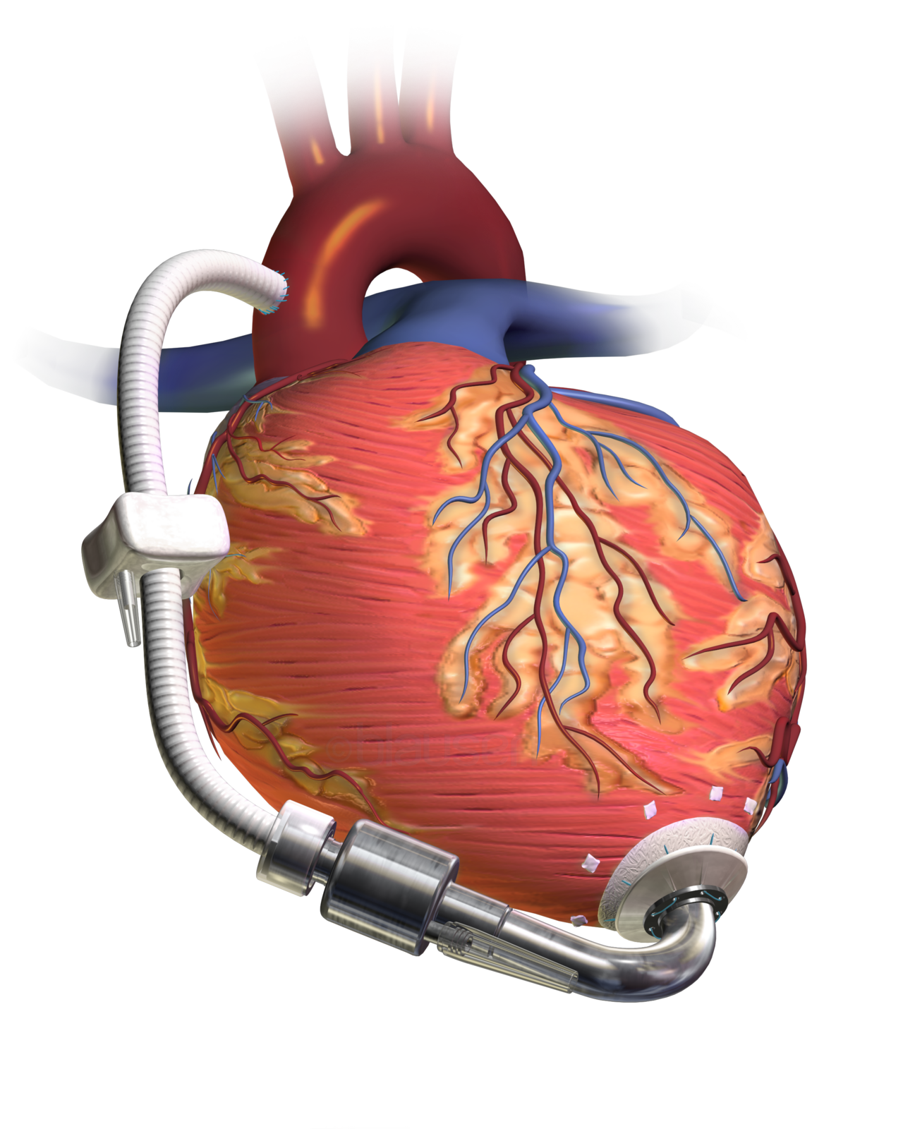 Generic continuous-flow LVAD illustration: inflow cannula at the left ventricular apex, pump, outflow graft to the ascending aorta and a driveline leaving the chest