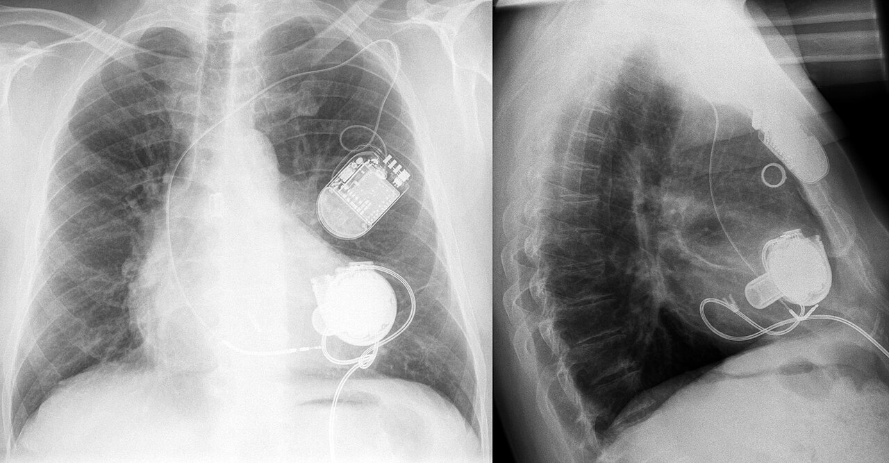 Chest radiograph showing an implanted LVAD and a separate implanted defibrillator