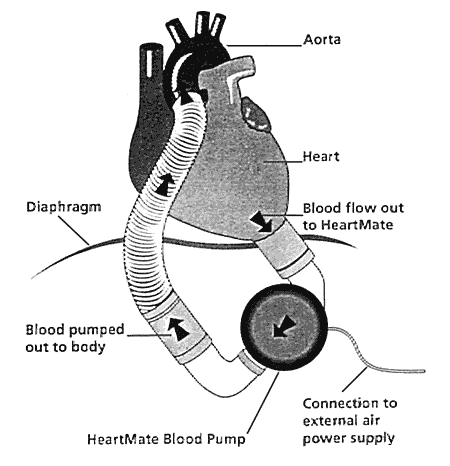 Diagram of an older air-driven HeartMate blood pump with flow from the left ventricle to the aorta and an external air power connection