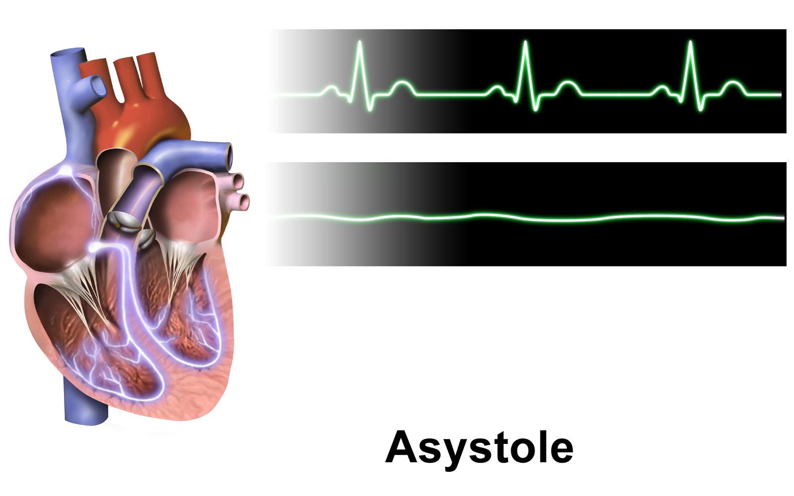 Asystole: flat lower strip with no QRS complexes, normal sinus rhythm in the upper strip