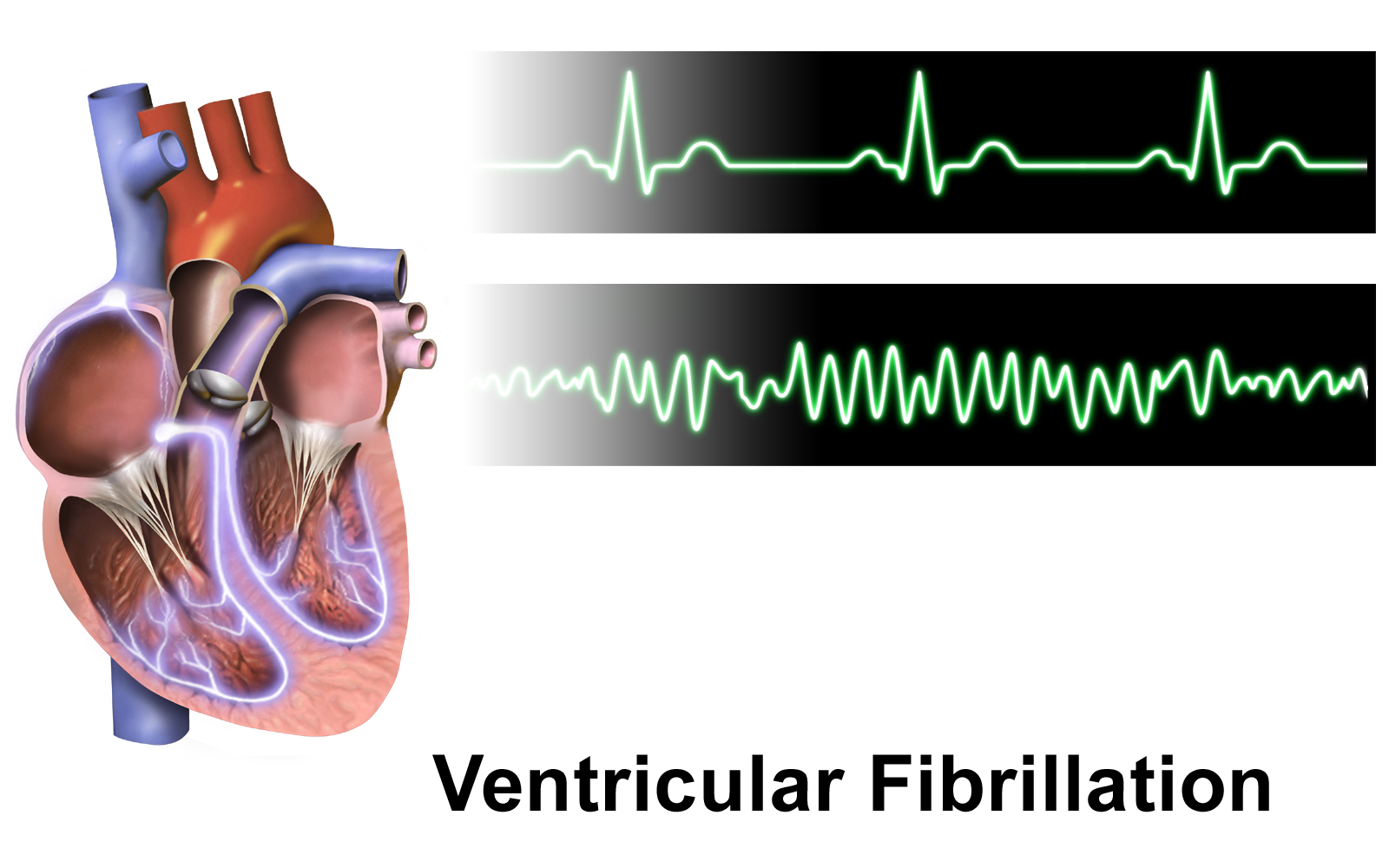 Ventricular fibrillation: chaotic waveform in the lower strip, normal sinus rhythm in the upper strip