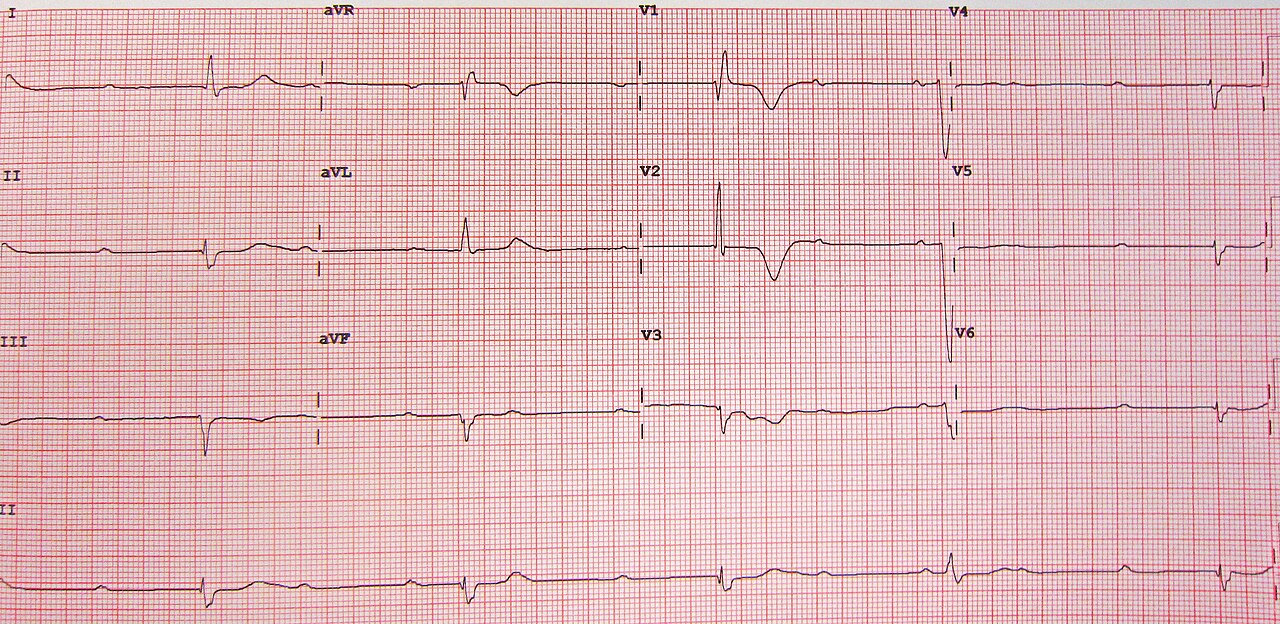 12-lead ECG of complete AV block with P waves and QRS complexes occurring independently