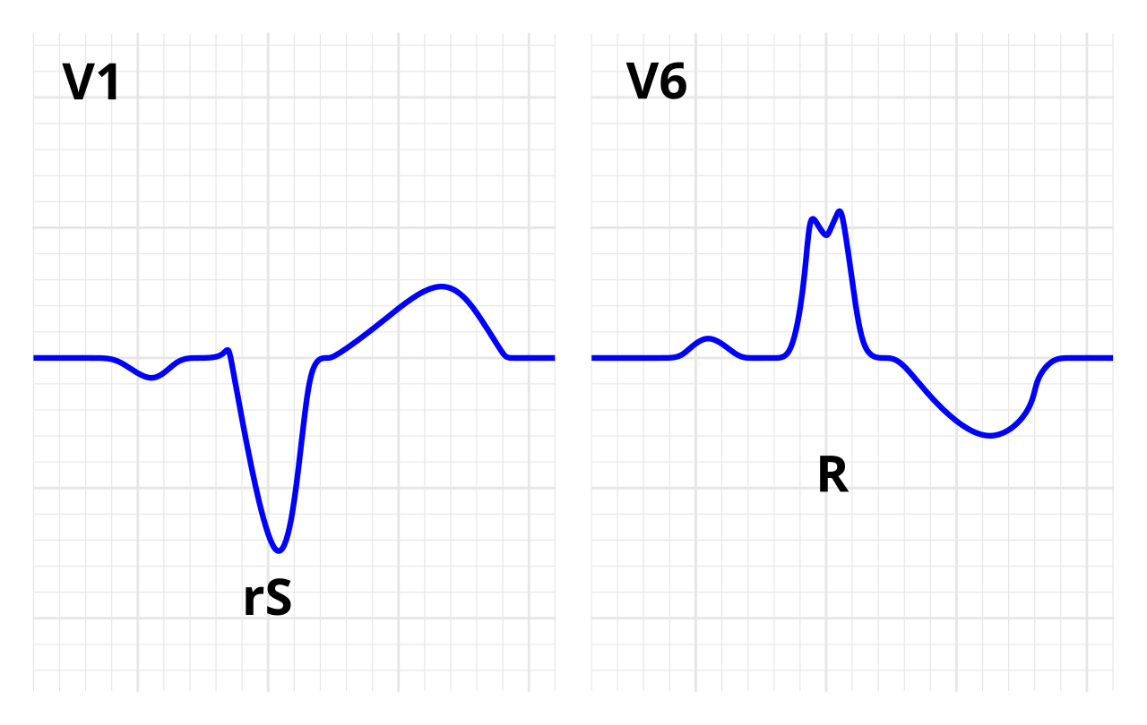 Left bundle branch block schematic: rS in V1 and a broad, notched R wave in V6