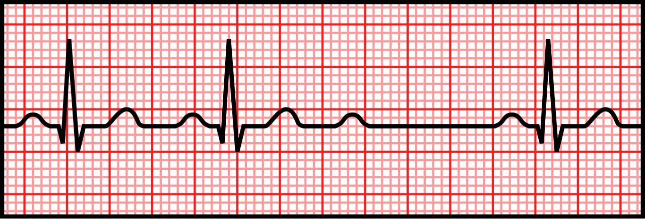 Mobitz II: constant PR intervals with P waves that fail to conduct and no QRS after them