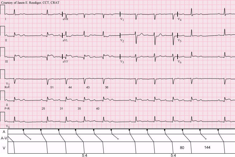 Type I second-degree AV block with 5:4 Wenckebach periods: PR lengthens across each group before a dropped QRS