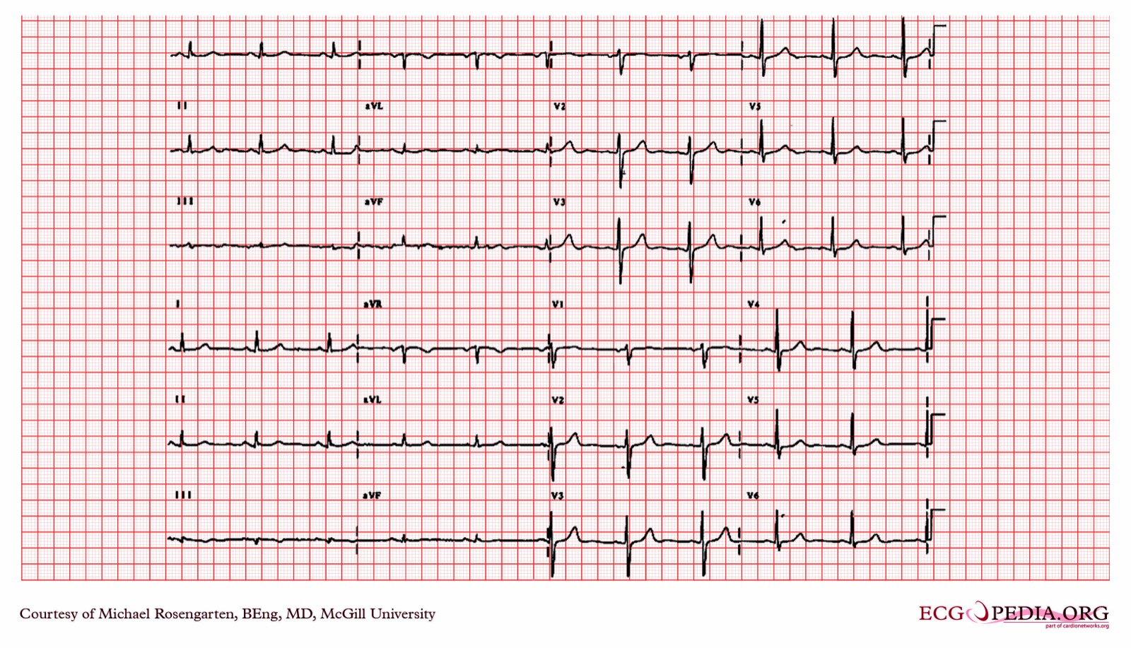 Two 12-lead ECGs from one patient; the lower tracing has the left arm and left leg leads reversed