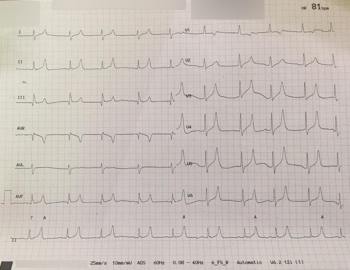 12-lead ECG with tall, narrow peaked T waves from a patient with kidney disease and potassium 8.2 mmol/L
