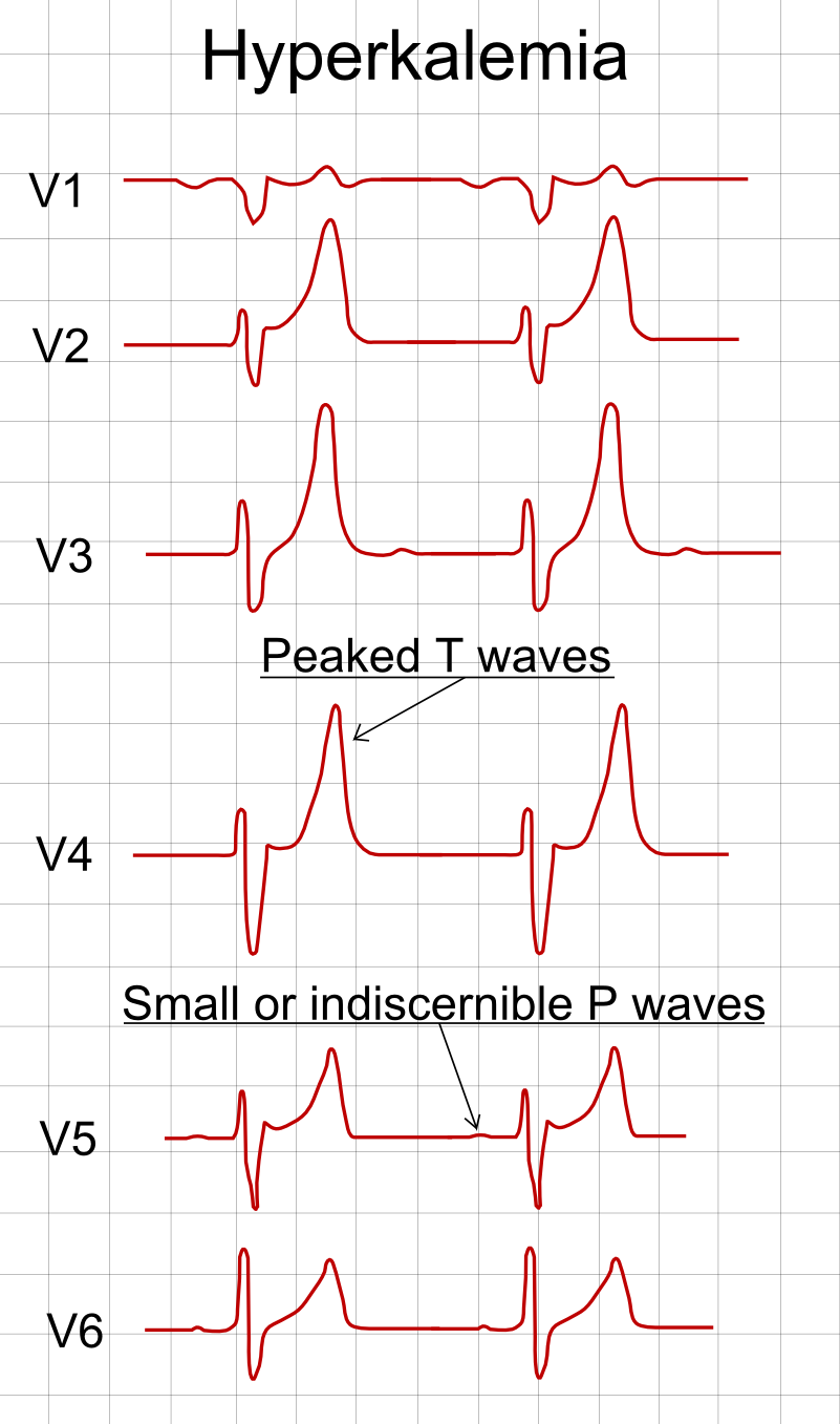 Schematic of precordial leads V1 to V6 in hyperkalemia: peaked T waves with small or indiscernible P waves