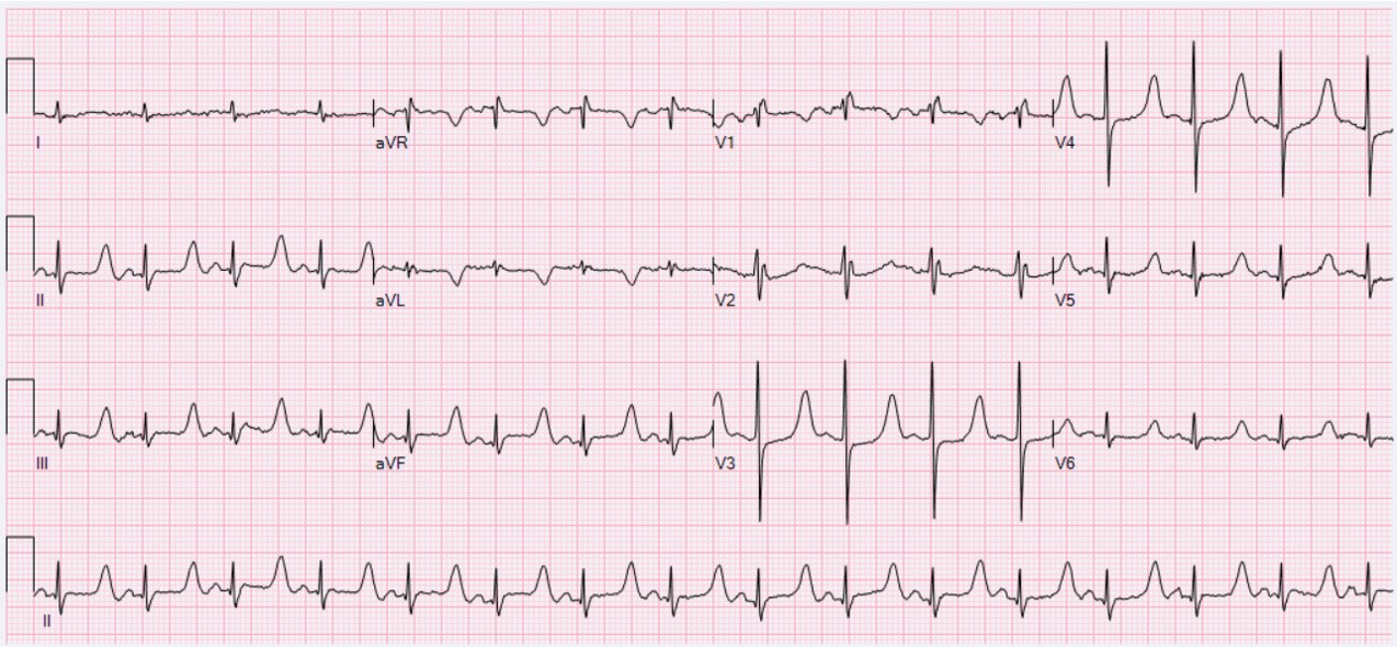 12-lead ECG in hypocalcemia: long ST segment and prolonged QT, QTc 584 ms