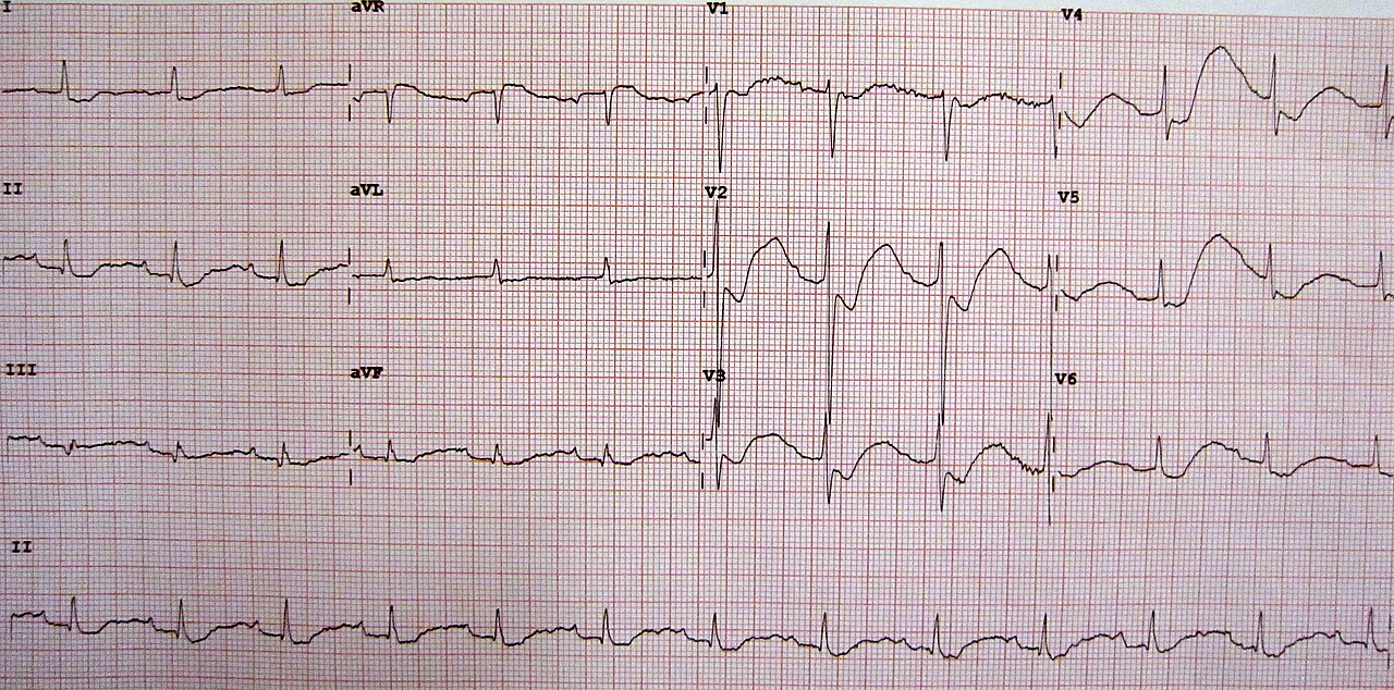 Severe hypokalemia: ST depression, inverted T waves and large U waves on a 12-lead ECG