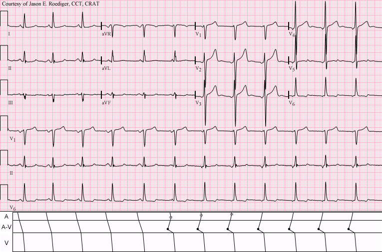 Rhythm strip changing from sinus rhythm with atrial fusion beats to accelerated junctional rhythm with retrograde atrial conduction