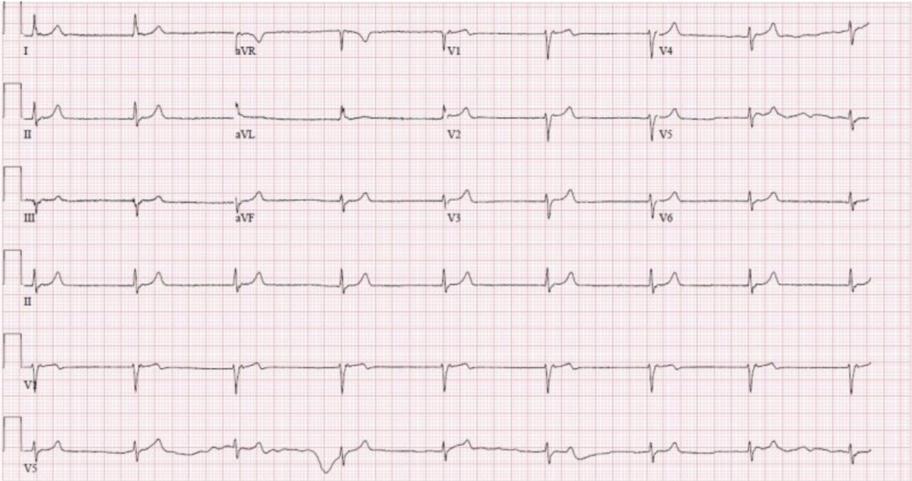12-lead ECG at about 50–60 bpm with regular narrow QRS complexes and no visible P waves before each QRS; an upright T wave follows each QRS in leads I, II and aVF