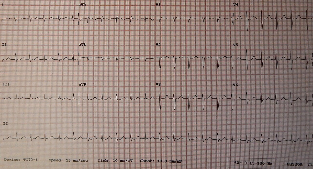 12-lead ECG of regular narrow-complex tachycardia above 100 bpm with no clearly visible P waves; lead II rhythm strip at the bottom